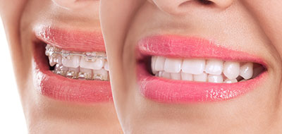 Purely Smiles Dental | Teeth Whitening, Initial Oral Exams and Root Canals