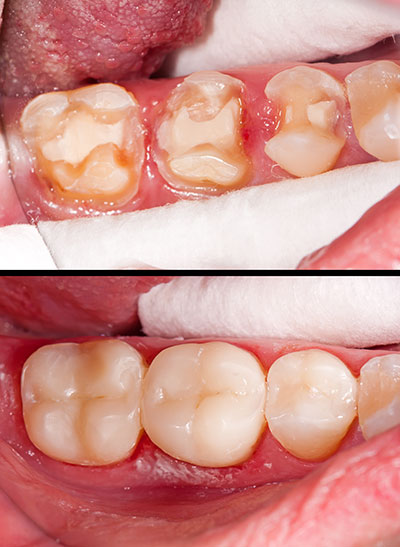 Purely Smiles Dental | Dental Fillings, Invisalign and Laser Dentistry