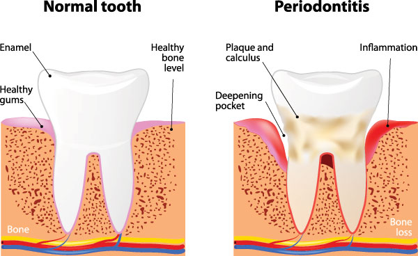 Purely Smiles Dental | Periodontal Treatment, Implant Dentistry and Night Guards